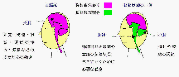 イラスト：全脳死・植物状態の一例