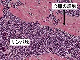 写真：リンパ球が異常に増えている様子